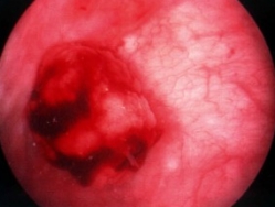 Рак мочевого пузыря